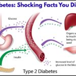 Type 2 Diabetes